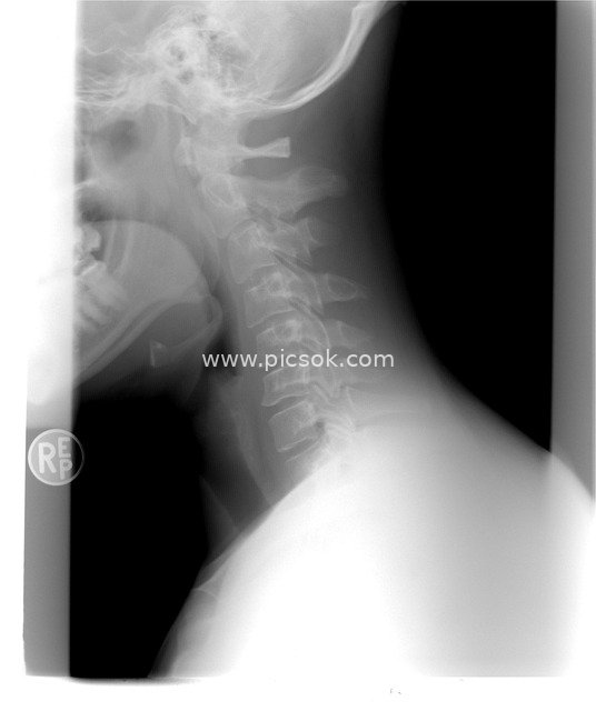 Cervical Spine X-Ray: Medical Imaging of the Human Neck Spine