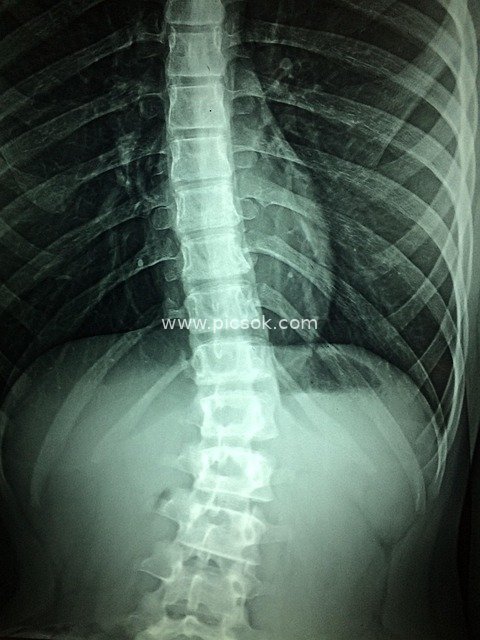 Human Spine X-Ray Image - Medical Diagnostic & Material